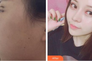 廈門海明醫(yī)療美容診所林偉亮整形價格表附鼻部案例展示