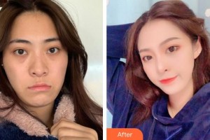 廈門蔡懿醫(yī)療美容診所謝樹榮整形價格表附埋線提升提升案例展示