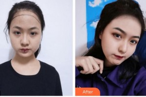 廈門碧蓮盛植發(fā)醫(yī)療美容門診部趙陽整形價格表附美女發(fā)際線種植案例展示