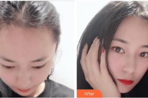 廈門碧蓮盛植發(fā)醫(yī)療美容門診部林威特整形價格表附發(fā)際線種植案例展示