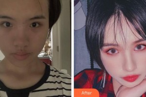 廈門顏施整形外科門診部林高萍整形價格表附面部埋線提升提升案例展示