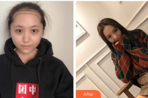 廈門重森植發(fā)整形外科門診部張斌奕整形價格表附發(fā)際線后移 女性發(fā)際線種植案例展示