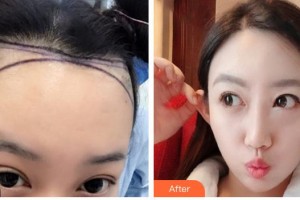 廈門重森植發(fā)整形外科門診部胡荔平整形價格表附發(fā)際線種植案例展示