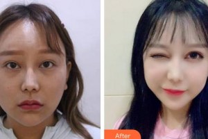 廈門市第三醫(yī)院眼科艾運旗整形價格表附雙眼皮+眼瞼下至案例展示