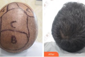 廈門雍禾植發(fā)醫(yī)療美容門診部王斌整形價格表附頭發(fā)種植案例展示