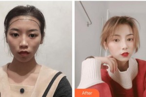 廈門雍禾植發(fā)醫(yī)療美容門診部鄧本文整形價格表附發(fā)際線高 發(fā)際線調(diào)整案例展示