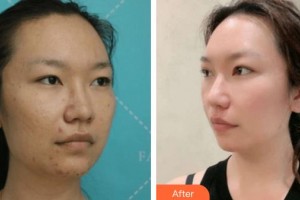 廈門大學(xué)附屬廈門眼科中心醫(yī)院盧奕整形價格表附雙眼皮案例展示