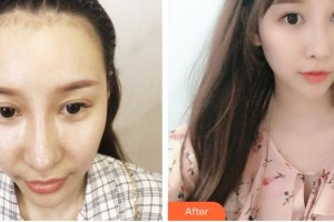 廈門雍禾植發(fā)醫(yī)療美容門診部潘朝林整形價格表附美人尖微創(chuàng)種植 發(fā)際線高案例展示