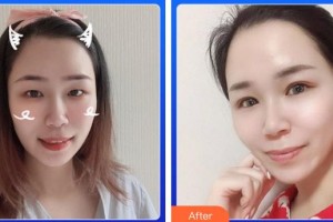 廈門大學(xué)附屬廈門眼科中心醫(yī)院劉旭陽整形價格表附5S重瞼術(shù)+超微創(chuàng)開內(nèi)眥案例展示