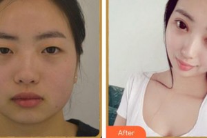 廈門大學(xué)附屬廈門眼科中心醫(yī)院毛祖紅整形價格表附眼部多項案例展示