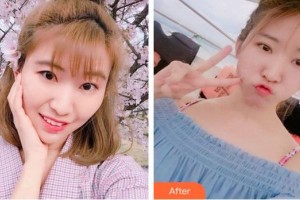 廈門大學(xué)附屬廈門眼科中心醫(yī)院李煒整形價格表附切開雙眼皮案例展示