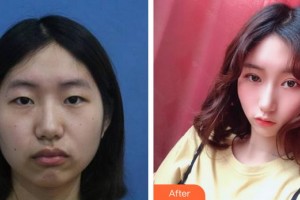 廈門大學(xué)附屬廈門眼科中心醫(yī)院李立梅整形價格表附上瞼微整案例展示