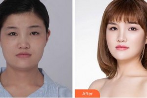 廈門大學(xué)附屬廈門眼科中心醫(yī)院何雪洪整形價格表附眼部綜合日記案例展示