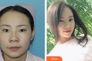 廈門大學(xué)附屬廈門眼科中心醫(yī)院楊麗杰整形價格表附精細切開雙眼皮案例展示