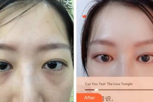 廈門大學(xué)附屬廈門眼科中心醫(yī)院許亞章整形價格表附內(nèi)路去眼袋案例展示