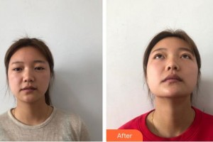廈門大學(xué)附屬廈門眼科中心醫(yī)院王晶整形價格表附美眼部手術(shù)案例展示