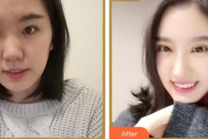 廈門大學(xué)附屬廈門眼科中心醫(yī)院李孟瓊整形價格表附眼部綜合案例展示