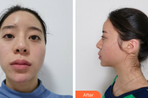 廣州博仕整形美容醫(yī)院蔡偉平整形價(jià)格表附切開雙眼皮案例展示