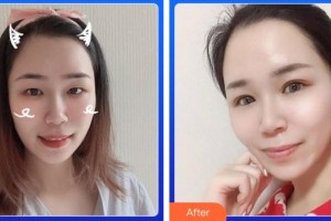 廈門大學(xué)附屬廈門眼科中心醫(yī)院李東侃整形價格表附眼部案例展示