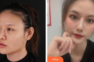 廈門大學(xué)附屬廈門眼科中心醫(yī)院徐靜靜整形價格表附眼部案例展示