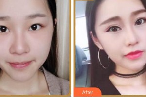 廈門大學(xué)附屬廈門眼科中心醫(yī)院范巍整形價格表附眼部綜合案例展示