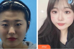 廈門大學(xué)附屬廈門眼科中心醫(yī)院林志榮整形價格表附埋線雙眼皮案例展示