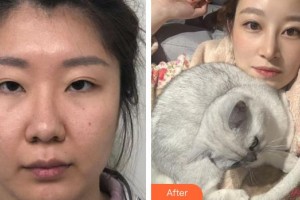 廈門大學(xué)附屬廈門眼科中心醫(yī)院商旭敏整形價格表附眼部整形案例展示