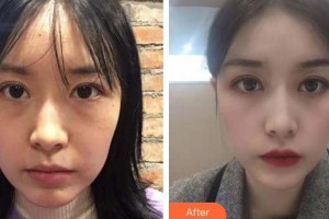 廈門大學(xué)附屬廈門眼科中心醫(yī)院董諾整形價格表附眼部案例展示