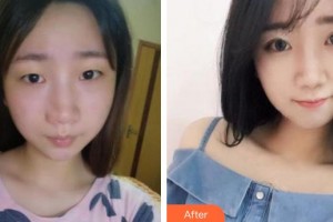 廈門大學(xué)附屬廈門眼科中心醫(yī)院葉梅整形價格表附自然雙眼皮案例展示