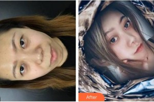 廈門大學(xué)附屬廈門眼科中心醫(yī)院曾宗圣整形價格表附切開雙眼皮案例展示
