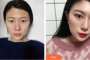 廈門大學(xué)附屬廈門眼科中心醫(yī)院付彥敏整形價格表附眼部手術(shù)案例展示