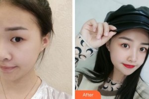 廈門大學(xué)附屬廈門眼科中心醫(yī)院莊建福整形價格表附眼部手術(shù)案例展示