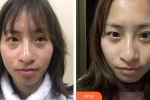 廈門大學(xué)附屬廈門眼科中心醫(yī)院修陽暉整形價格表附不開刀去眼袋+淚溝填充案例展示