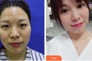 廈門大學(xué)附屬廈門眼科中心醫(yī)院陳雙成整形價格表附全切雙眼皮案例展示
