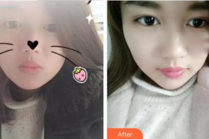廈門大學附屬廈門眼科中心醫(yī)院楊美瓊整形價格表附眼部手術(shù)案例展示