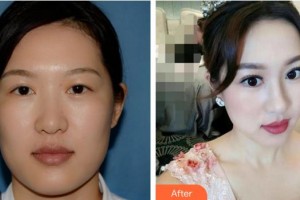 廈門大學附屬廈門眼科中心醫(yī)院謝仁藝整形價格表附雙眼皮修復(fù)案例展示