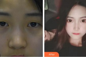 廈門大學附屬廈門眼科中心醫(yī)院陳文生整形價格表附眼部手術(shù)案例展示