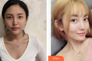 廈門大學附屬廈門眼科中心醫(yī)院楊梅整形價格表附眼部手術(shù)案例展示
