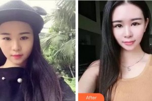 廈門大學附屬廈門眼科中心醫(yī)院沈政偉整形價格表附雙眼皮修復(fù)快三個月案例展示