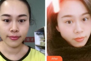 廈門大學附屬廈門眼科中心醫(yī)院王海燕整形價格表附眼部手術(shù)案例展示