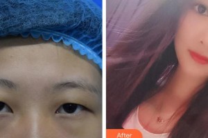 廈門大學附屬廈門眼科中心醫(yī)院王曉波整形價格表附眼部手術(shù)案例展示