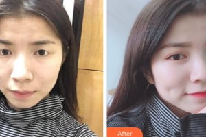 廈門大學附屬廈門眼科中心醫(yī)院李海波整形價格表附眼部案例展示