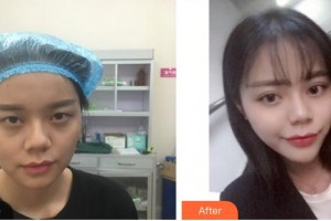 廈門大學附屬廈門眼科中心醫(yī)院李瑞霞整形價格表附眼部手術(shù)案例展示