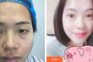 廈門科宏眼科醫(yī)院楊鵬飛整形價格表附切開雙眼皮案例展示
