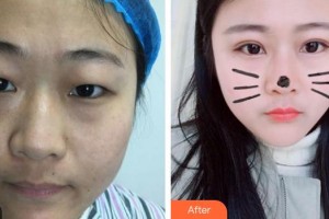 廈門科宏眼科醫(yī)院劉俠整形價格表附單眼皮變雙眼皮案例展示