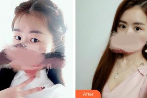 廈門科宏眼科醫(yī)院黃磊整形價格表附雙眼皮案例展示