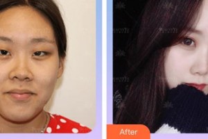 廈門科宏眼科醫(yī)院許丁木整形價格表附雙眼皮+開內眼角案例展示