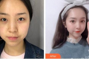 廈門市海滄醫(yī)院眼科林毓妮整形價格表附眼部手術案例展示