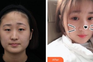 廈門市海滄醫(yī)院眼科張萌整形價格表附眼部手術案例展示