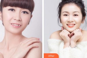 廈門峰煜口腔門診部沈賢生整形價格表附隱形托槽矯正案例展示